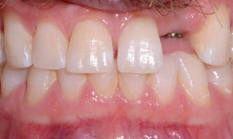 missing front tooth before dental implant