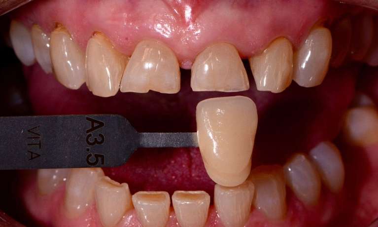 before teeth whitening
