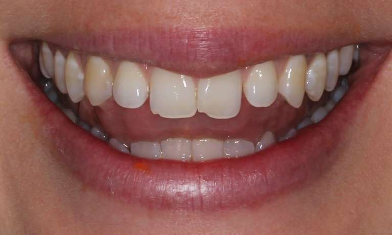 chipped front tooth before invisalign and bonding