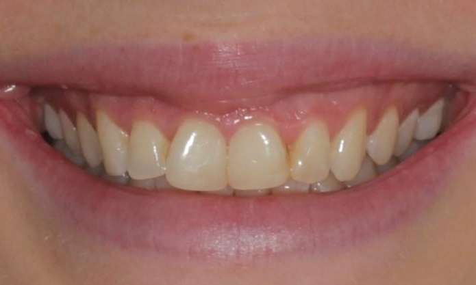Smile before clear aligners 