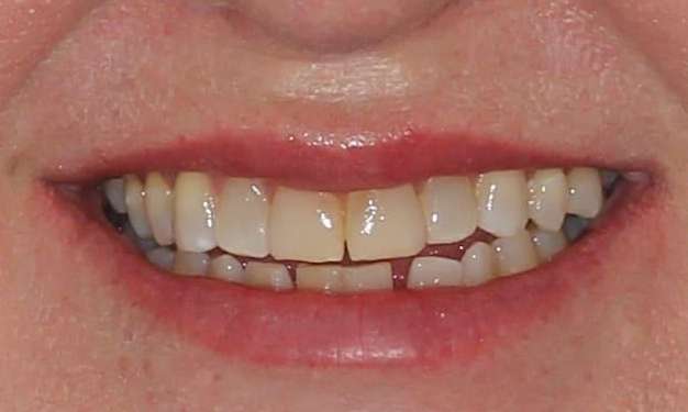 drab teeth before veneers and whitening