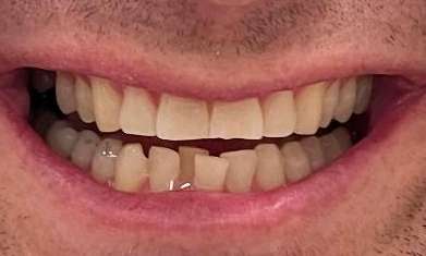 Invisalign-Teeth-Whitening-and-Composite-Bonding-Before-Image