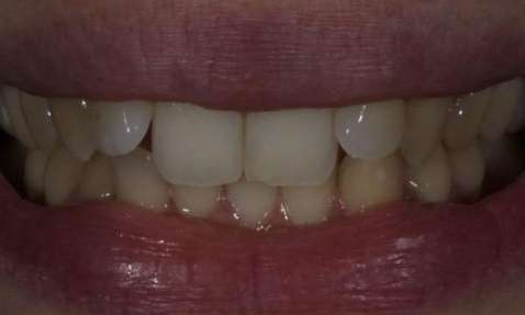 smile before invisalign treament