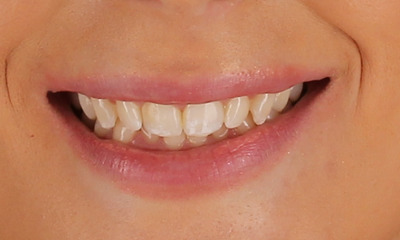Before treatment - Invisalign®