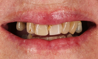 Before treatment - Porcelain Crowns and Bridges Transformation