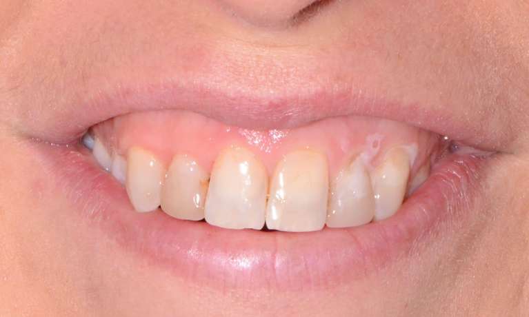 stained and dull teeth before veneers