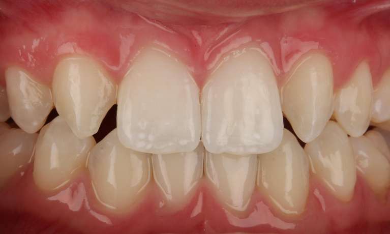 smile before teeth whitening and veneers