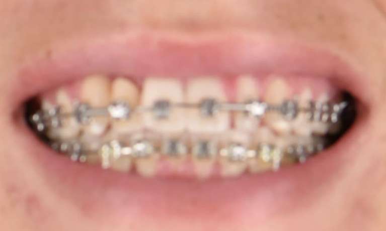 Close up of patient's teeth with metal braces