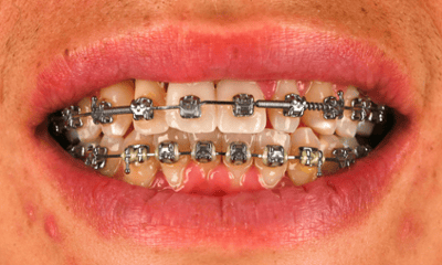 Post-Ortho-Finishing-Touches-Teeth-Whitening-Bridge-and-Composite-Veneer-Before-Image