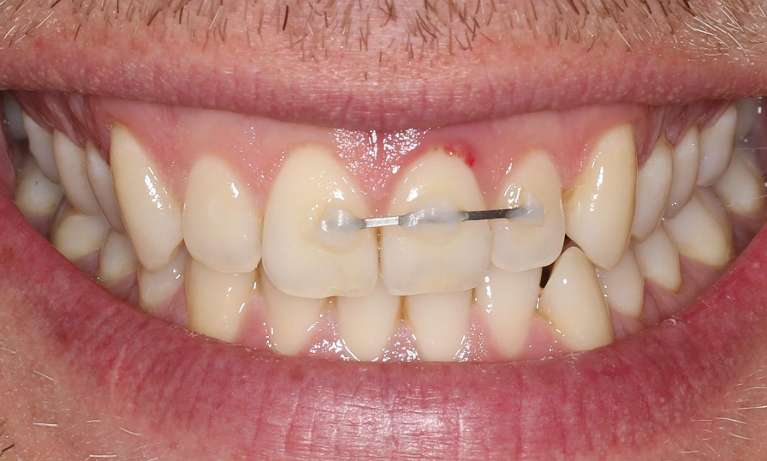 before image of tooth replacement with single dental implant 