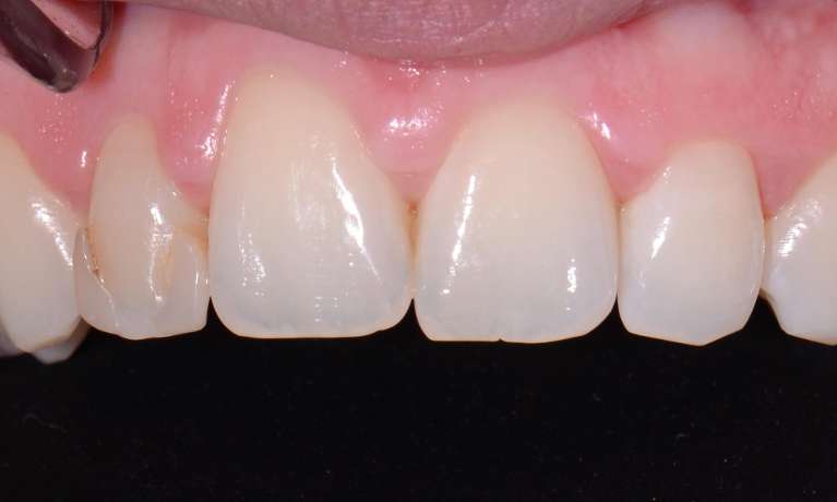 old veneer before treatment