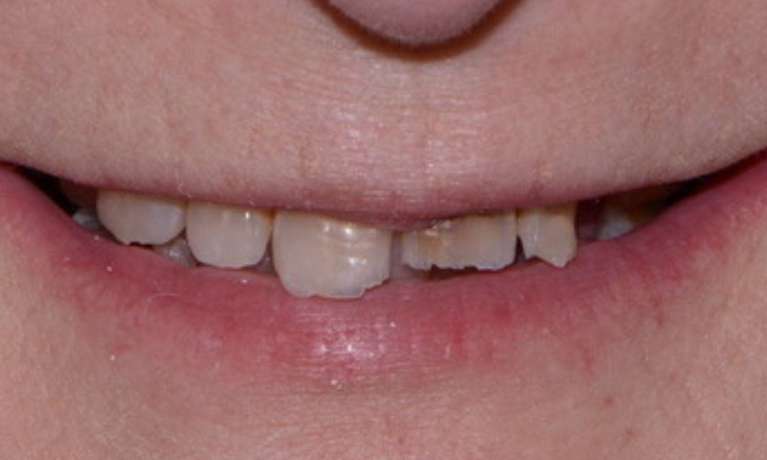 Smile-Makeover-From-Tooth-Damage-Before-Image
