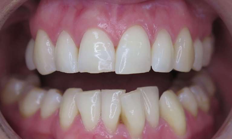 Smile-Makeover-with-Dental-Implants-Before-Image