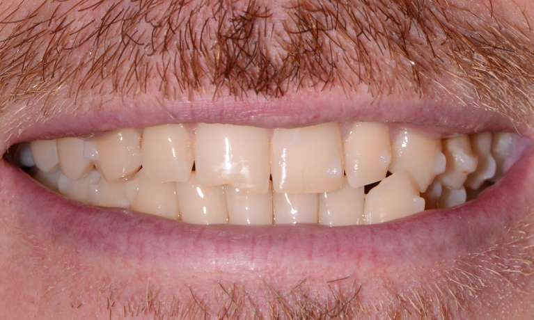 Smile-Makeover-Align-Bleach-Bond-Before-Image