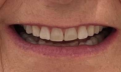 Smile-Makeover-Before-Image