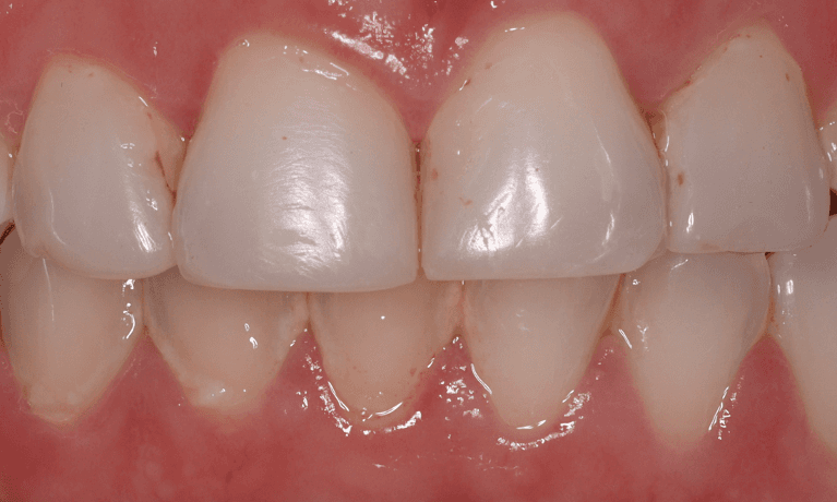 front teeth before veneers