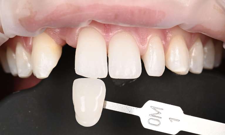 smile with gaps after orthodontic treatment