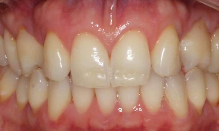 misshaped teeth before whitening and bonding