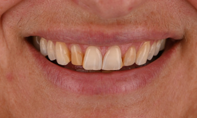 discoloured front teeth 