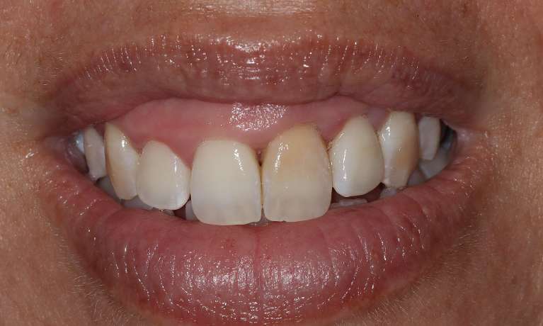 discoloured front teeth before whitening