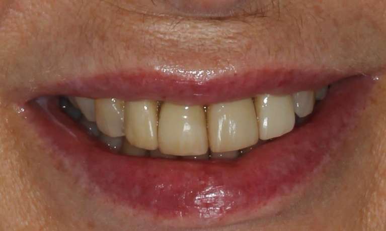 old and worn dental veneers on front teeth