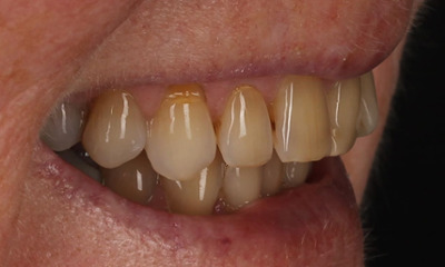 Teeth Whitening before