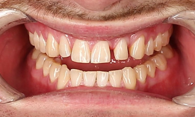 Before treatment - Clear Aligners, with Composite Veneers