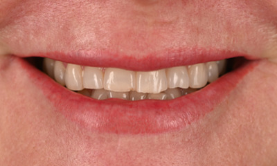 teeth before whitening and veneers