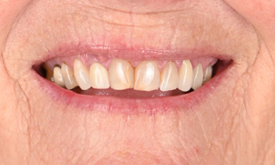 before front tooth with broken root
