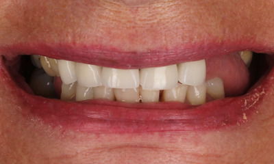 Partial Dentures Before