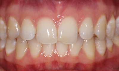 chipped front tooth before invisalign and bonding