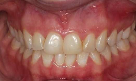 Smile before clear aligners 