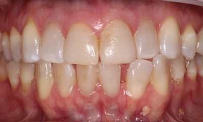 drab teeth before veneers and whitening