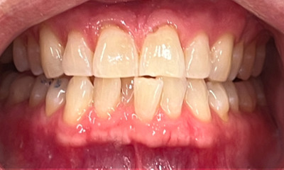 uneven smile with crooked bottom teeth before whitening