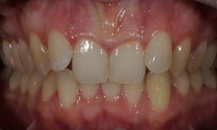 close up of smile before invisalign 