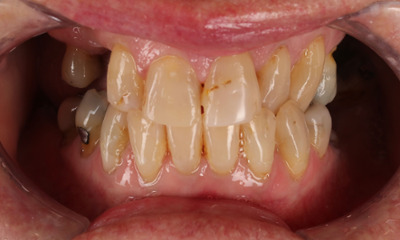 Before treatment - Porcelain Crowns and Bridges Transformation
