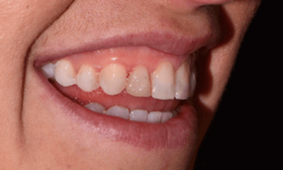 stained and dull teeth before veneers