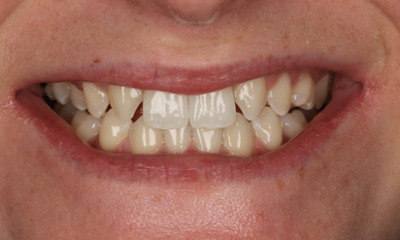 smile before teeth whitening and veneers