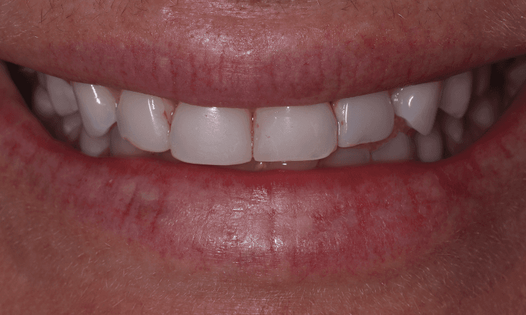 front teeth before veneers