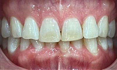 worn and dull front teeth