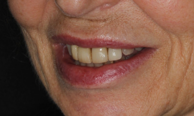 old and worn dental veneers on front teeth