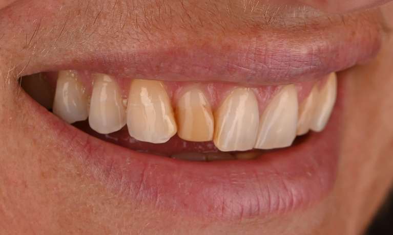 small, discoloured tooth before veneers