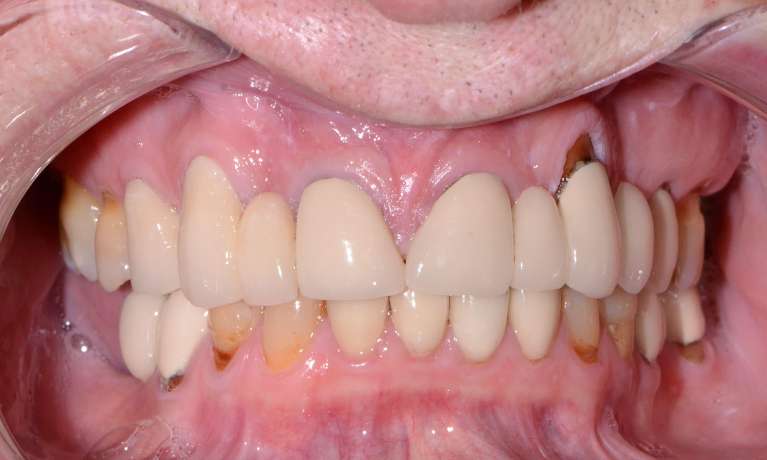 old and broken crowns and fillings in patient's smile