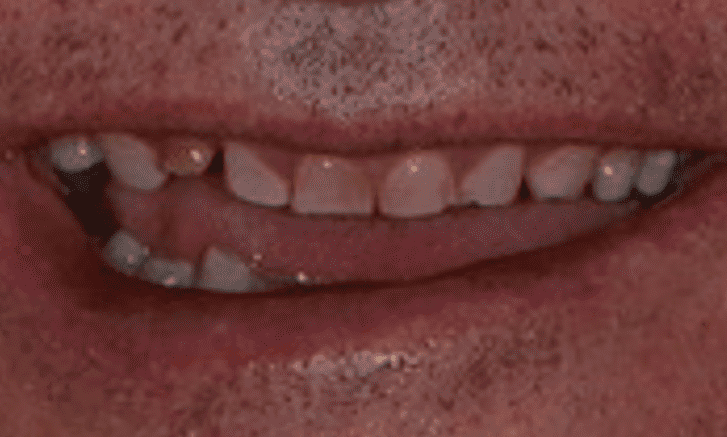 patient before new crowns and veneers and implants in warners bay