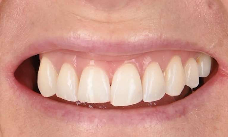 misaligned teeth before smile makeover
