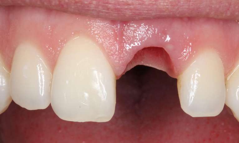 patient with missing tooth before replacement