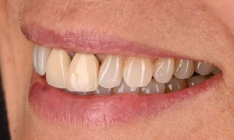 slight discoloration on teeth