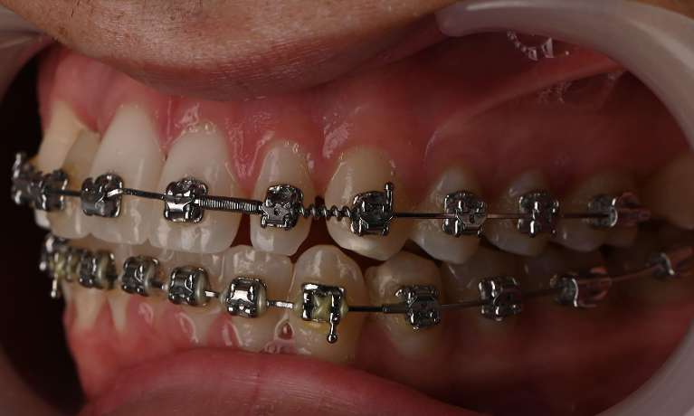 Close up of patient's teeth with metal braces