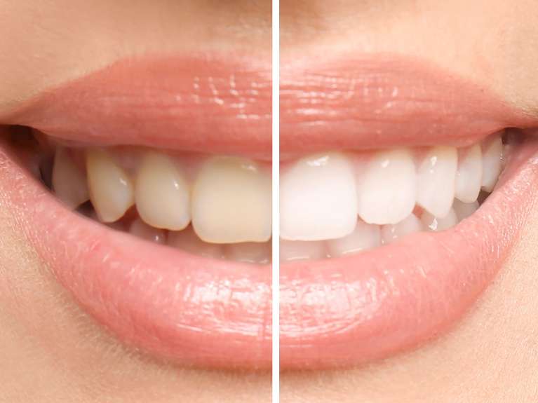 tooth whitening options in warners bay